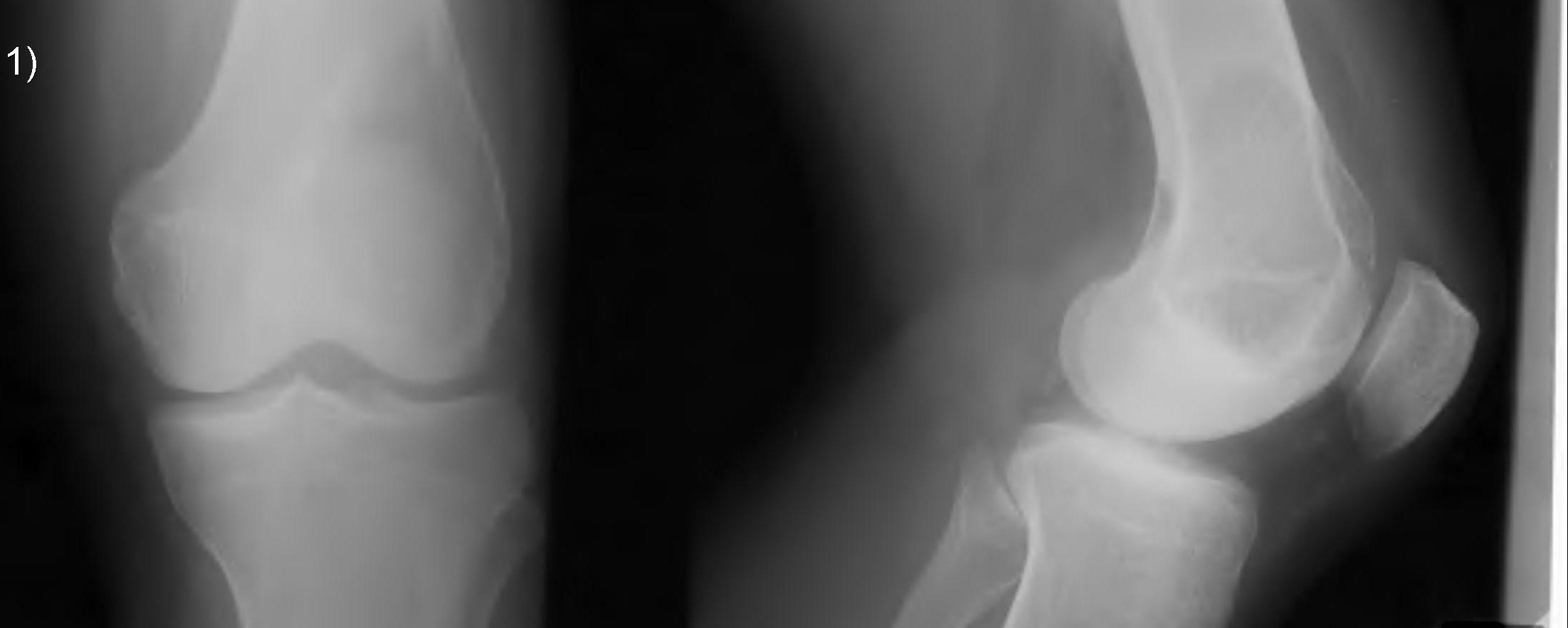 GCT Distal Femur Xray